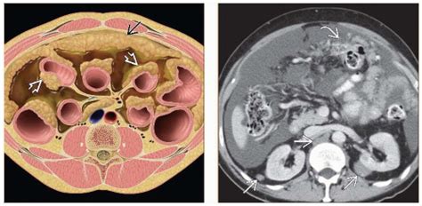We did not find results for: Peritoneal Metastases | Radiology Key