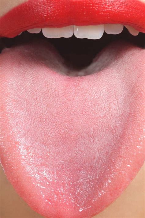 Purple Bump On Tongue