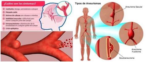 Aneurisma Causas Tipos S Ntomas Complicaciones Diagn Stico