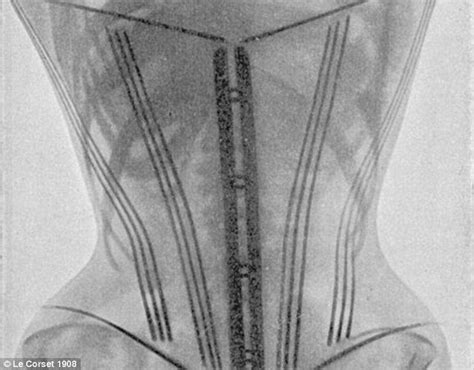 From Squashed Ribs To Displaced Spleens Vintage X Rays Reveal The Shocking Impact Corsets Had On