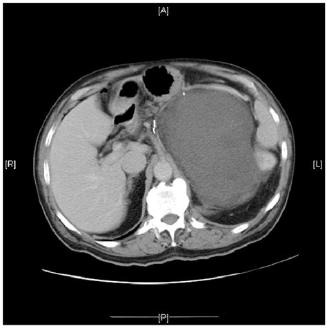 A 16 Month Abdominal Ct Showing Large Left Liposarcoma Recurrence With