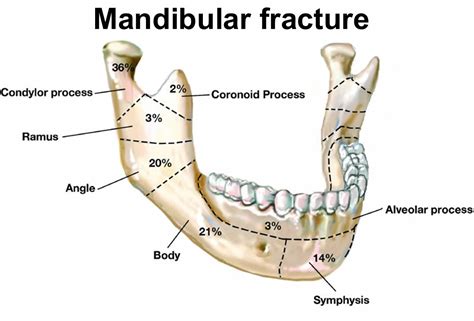 Mandibular Jaw Fracture