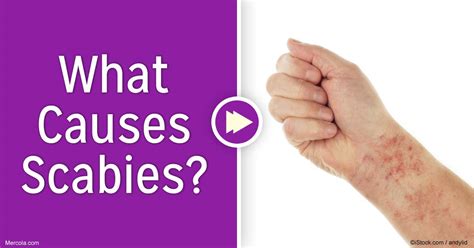 what does scabies look like