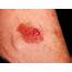 Squamous Cell Carcinoma Risks And Diagnosis