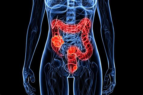 Better Survival For Colon Cancer Patients With Left Sided Tumors Uc