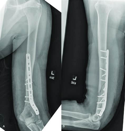Immediate Postoperative Anteroposterior A And Lateral B Radiographs