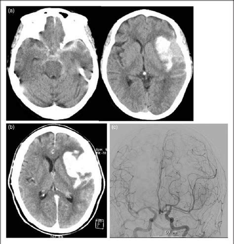 Figure 1 From Subarachnoid And Intracerebral Hemorrhage From