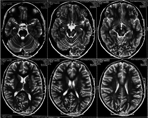 Mri Brain Showing T1 Hypointense And T2flair Hyperintense Lesions In
