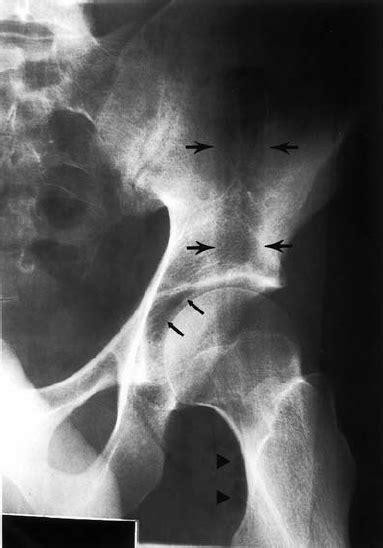 Pelvic Ap Radiograph Shows A Small Amount Of Subcutaneous Air Around