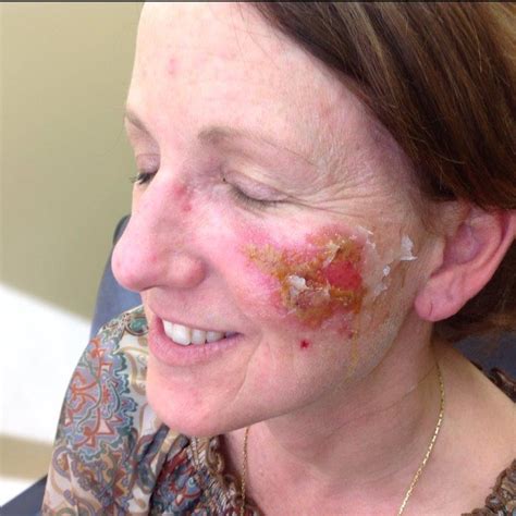 Before And After Pictures Of Actinic Keratosis In Charlotte Nc And