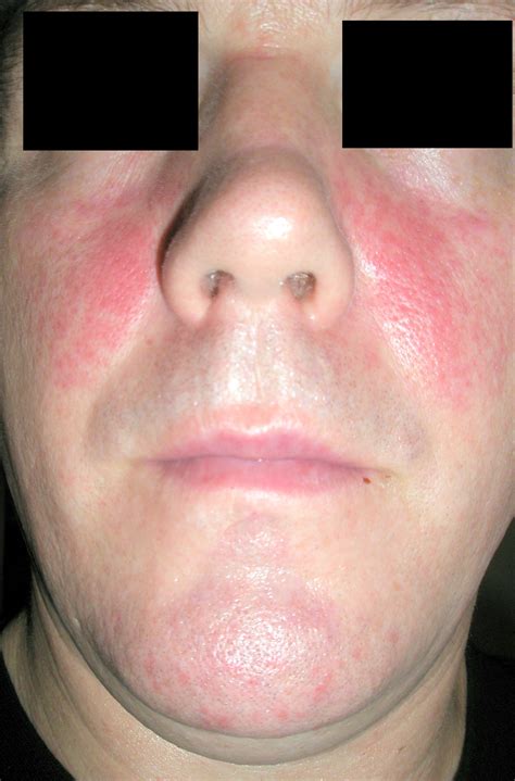 Red Spots On The Face And Red Cheeks The Commonest