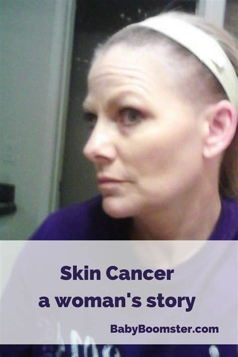 Effective treatment is possible in many cases. Skin Cancer is Not Something to Be Taken Lightly - A Woman ...