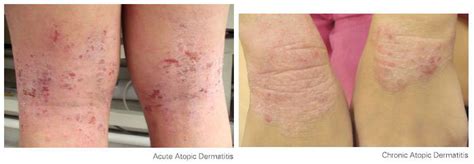 Atopic Eczema Symptoms In Infants Skin Rash Treatment Atopic