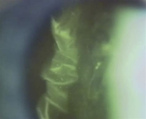 Vitrectomy For Vision Degrading Myodesopsia Ophthalmology Retina
