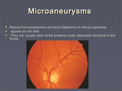 Dot and blot haemorrhages arise from bleeding capillaries in the middle layers of the retina. Diabetic retinopathy for medical student