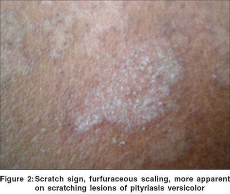 Scaly Signs In Dermatology Indian Journal Of Dermatology Venereology