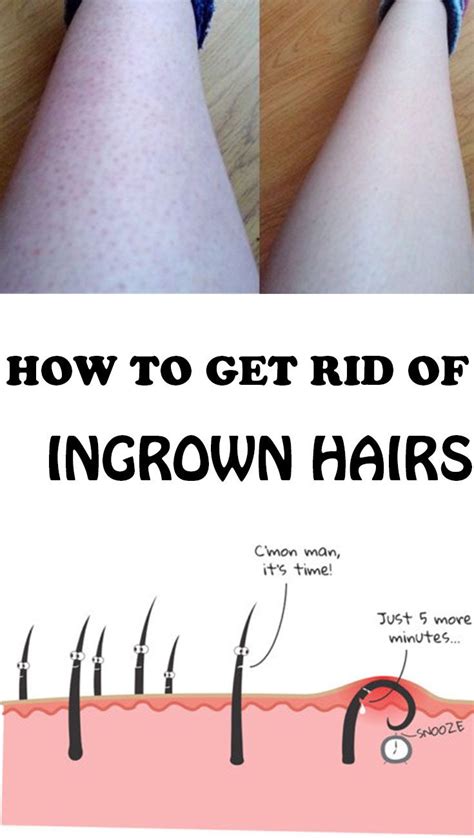 How To Get Rid Of Ingrown Hairs Ingrown Hair Ingrown Hair Ingrown