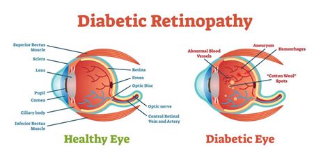 Diabetic Retinopathy Diagnosis And Treatments Asia Retina Singapore