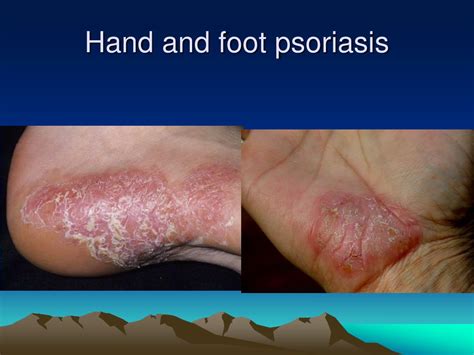 Ppt Psoriasis Powerpoint Presentation Free Download Id3042608