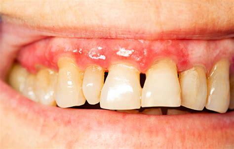 The Effects Of Sugar On Your Teeth And Why Its Bad For You