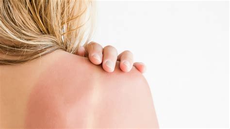 Solarni Dermatitis Kod Odraslih Uzroci Simptomi Dijagnoza I My XXX