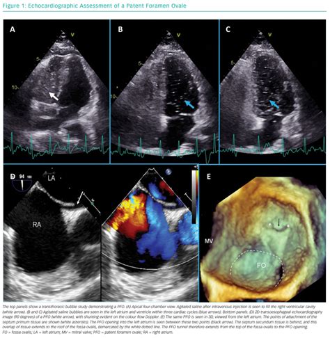 Echocardiographic Assessment Of A Patent Foramen Ovale Radcliffe