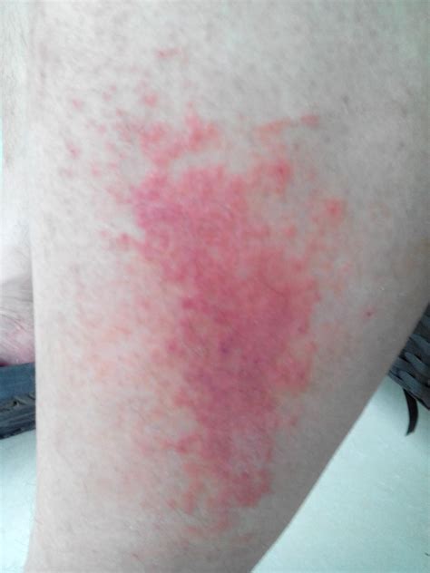 腿上有大面积的红色疹子 瘙痒 复发性强 看看有什么解决办法 有图片百度知道