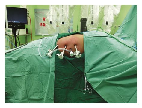 Trocar Positions For Pyeloplasty With Da Vinci Robotic System A C Download Scientific