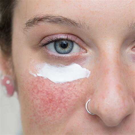 Treating Rosacea On The Face Spot Check Skin Cancer Aesthetics
