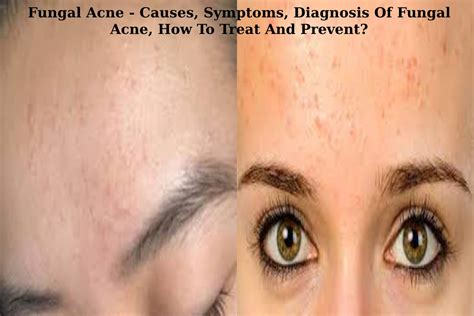 Fungal Acne Causes Symptoms Diagnosis How To Treat And Prevent