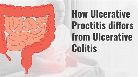 Ulcerative Proctitis Vs Colitis Causes Symptoms Treatment