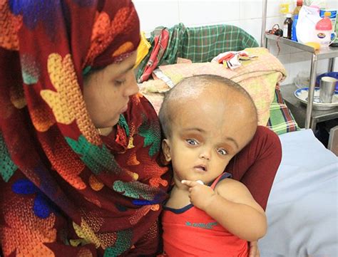 Baby Suffering From Hydrocephalus Had A Head Measuring 69cm