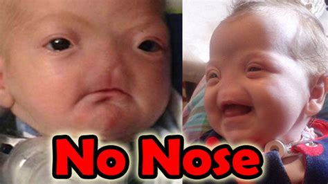 Baby Born Without Nose Shocking Video Dailymotion