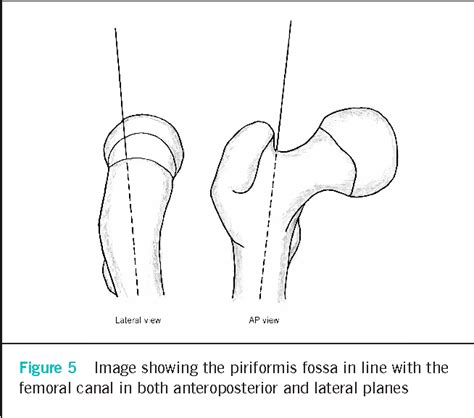 Figure 5 From Piriformis Fossa Approach In Optimising Femoral Neck