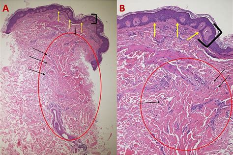 Histologic Features Of Atrophic Dermatofibroma On The Left Shoulder Of