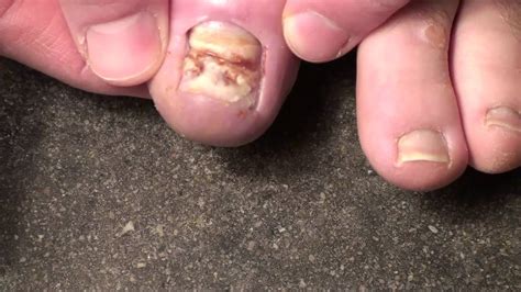 There would be fewer nail parlors. Toenail Removal - YouTube