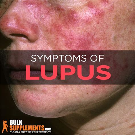 What Is Lupus Signs Causes Symptoms Treatment