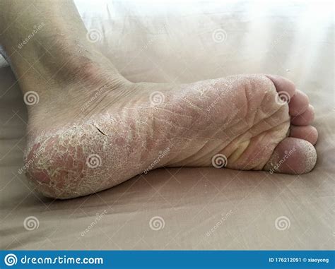 Sole Callus Foot Dry Skin Cracks Stock Image Image Of Foot Cracks