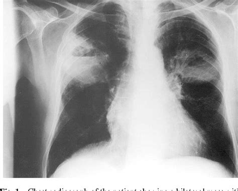 Figure 1 From Chronic Necrotizing Pulmonary Aspergillosis Semantic
