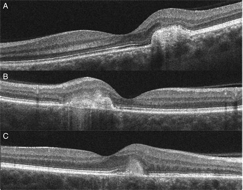 Choroidal Neovascularisation On Optical Coherence Tomography