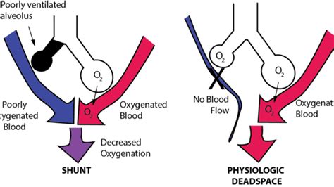 Apneic Oxygenation What Is It And How Do We Do It