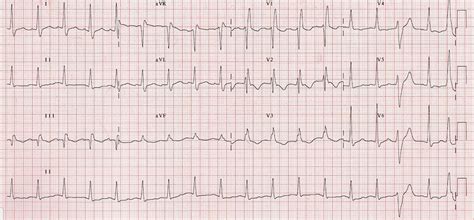 Around 18% of patients with pe will have a completely normal ecg. Pľúcna embólia (EKG kniha) | TECHmED