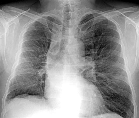 L'embolia polmonare rappresenta la terza causa di patologia cardiovascolare dopo l'infarto miocardico e l'ictus cerebrale. Cosa non va in questo torace? « unradiologo.net