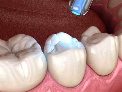 4 Dental Filling Options Plainview Dental Plainview New York