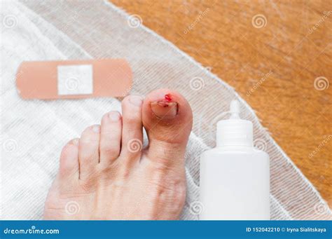 Man With Painful And Inflamed Gout On His Foot Around The Big Toe Area