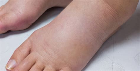Causes Of Swollen Ankles In Diabetics Diabeteswalls