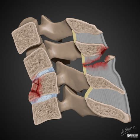 Flexion Teardrop Fracture Illustration Radiology Case Radiopaedia