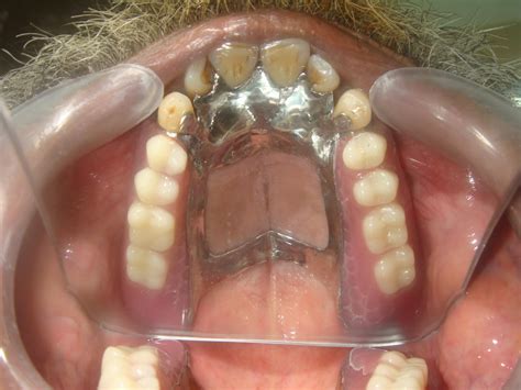 Understanding Prosthodontics Tagore Dental College And Hospital By