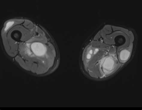 A Case Of Multiple Thigh Abscesses In A Patient With Multiple Myeloma