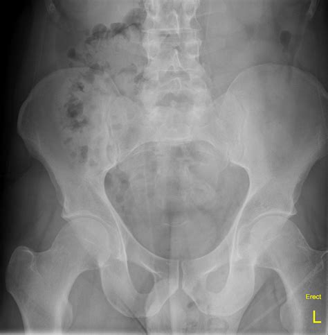 Left Inguinal Hernia On Abdominal X Ray X Ray Radiology Hernia Inguinal